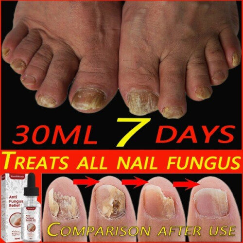 Nailr Fungal Treatment Feet Care Essence Anti Infection Paronychia Onychomycosis Toe Nail Fungus Removal Gel