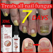 Nailr Fungal Treatment Feet Care Essence Anti Infection Paronychia Onychomycosis Toe Nail Fungus Removal Gel